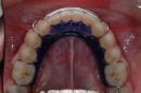 spring aligner, ortodonzia mobile, placca rimovibile